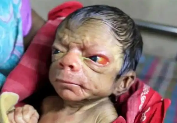 See this baby boy born with rare condition that makes him look like an 80yr old man (photos)